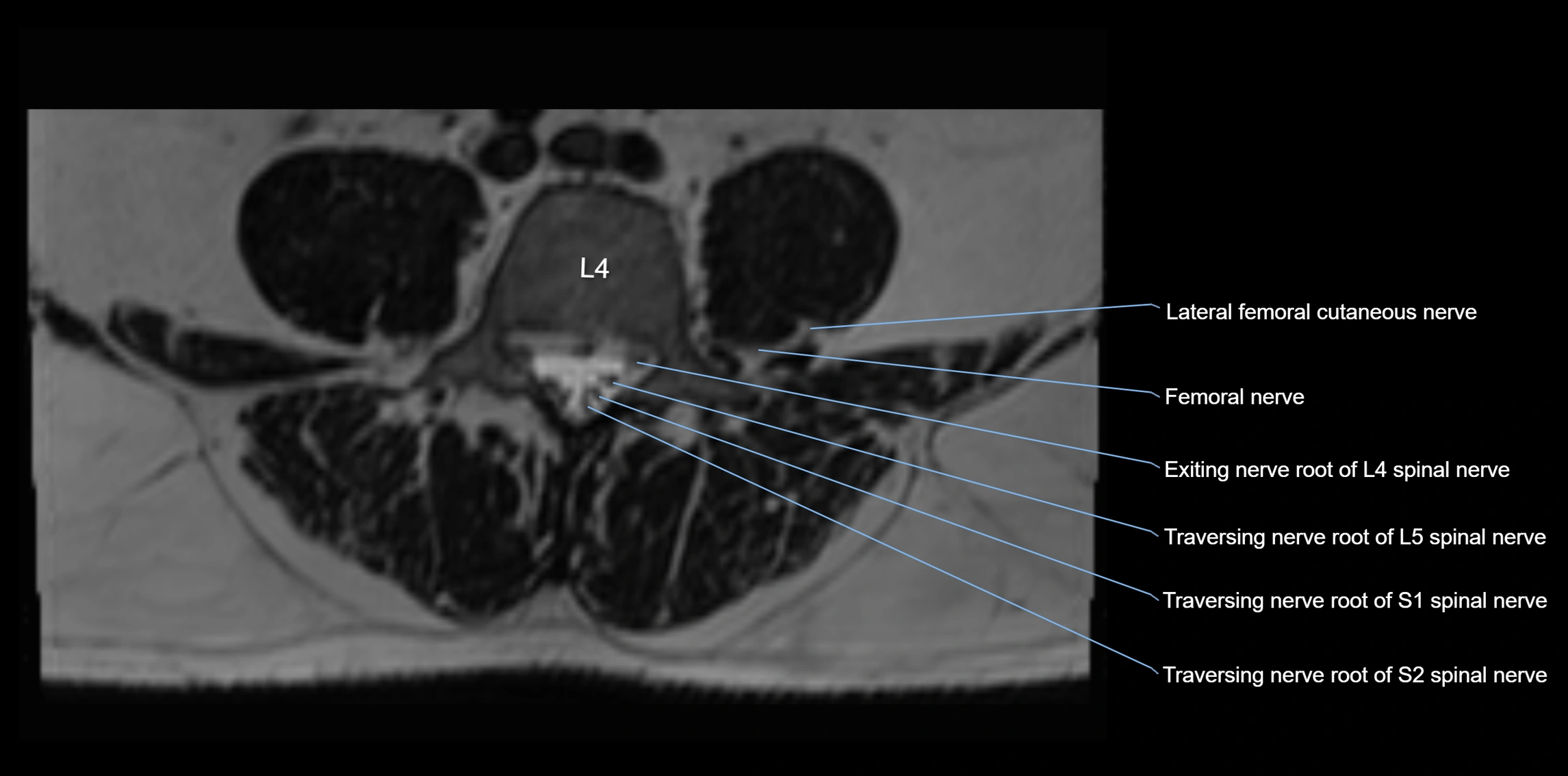 MR lumbosacral plexus axial cross sectional anatomy 3T  radiology  image-img-1008001-00039.webp